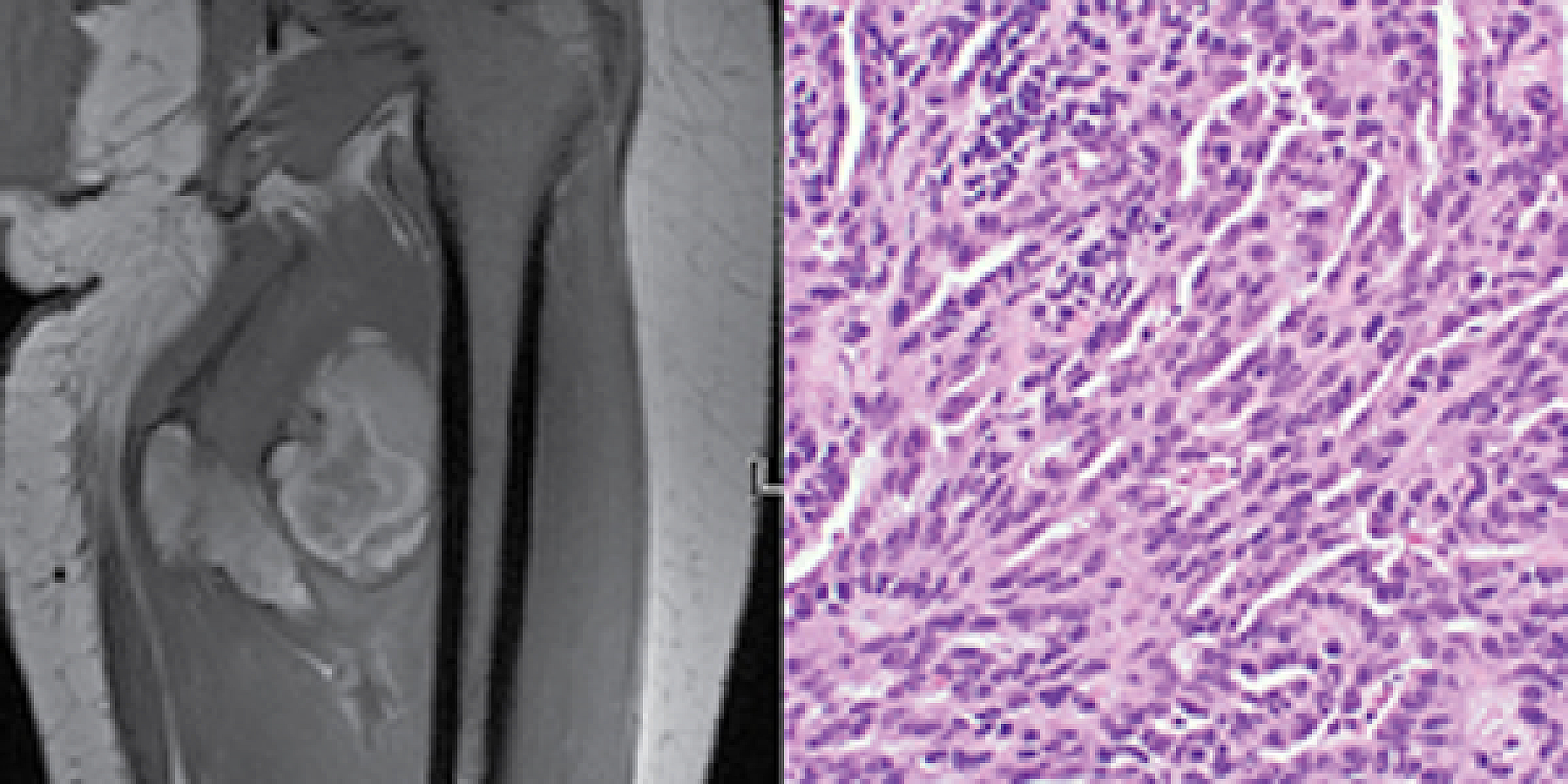 Imaging of synovial sarcoma in thigh