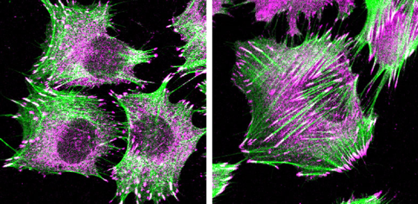 Ewing sarcoma cells expressing the EWS/FLI oncoprotein (left) or with knockdown of EWS/FLI (right) exhibit vastly different cell behavior. Cells were stained for F-actin (green) and the focal adhesion marker paxillin (magenta).