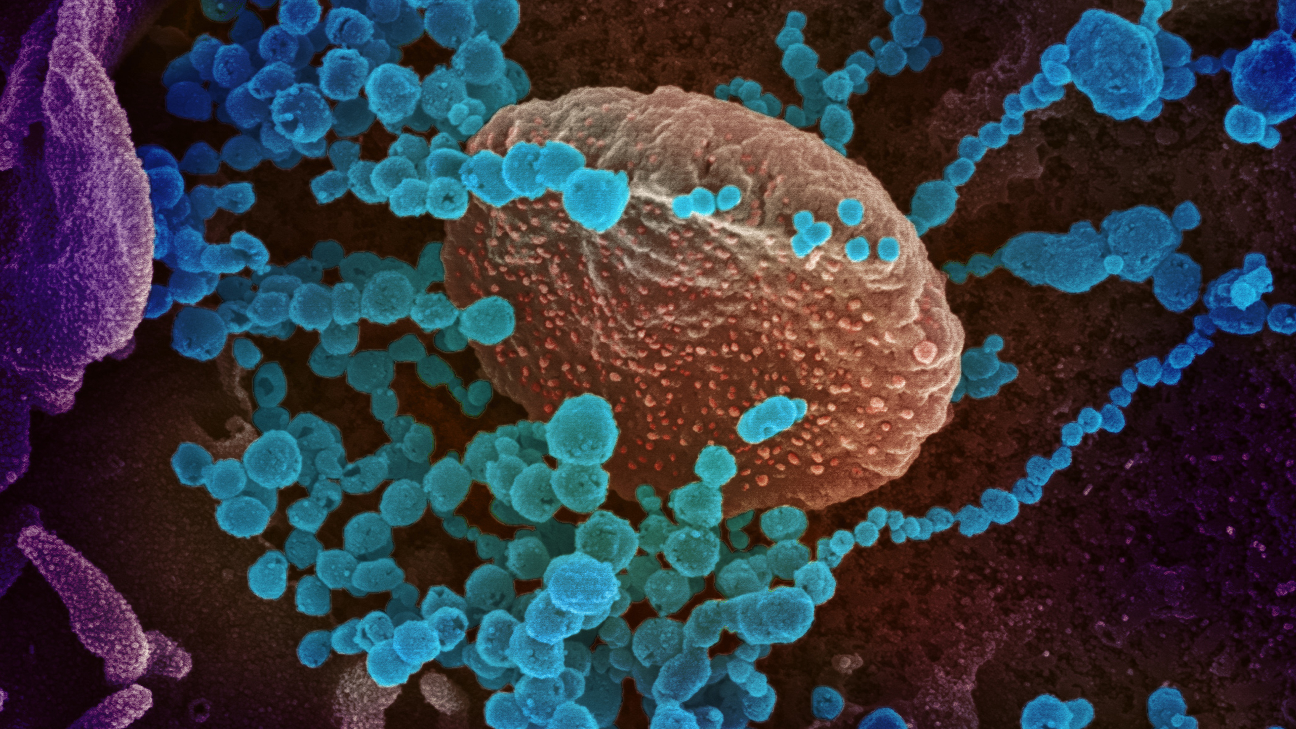 Research Finds Potential “Molecular Mimics” Behind Covid-Induced Autoimmune Disease