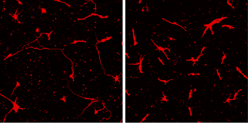 (Left) Brain cells from an unaffected individual have long processes called neurites. (Right) Brain cells from child with pediatric bipolar disorder has short neurites. Neurites forge important connections with neighboring cells.