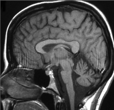 MRI showing cerebellum (base of the brain) and brain stem atrophy in a patient with Spinocerebellar Ataxia type 2.