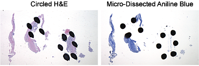 Examples of microdissection with dots circling the tumor area of H&E and micro-dissected aniline blue slides