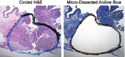 Examples of microdissection with circle around the tumor area of H&E and micro-dissected aniline blue slides