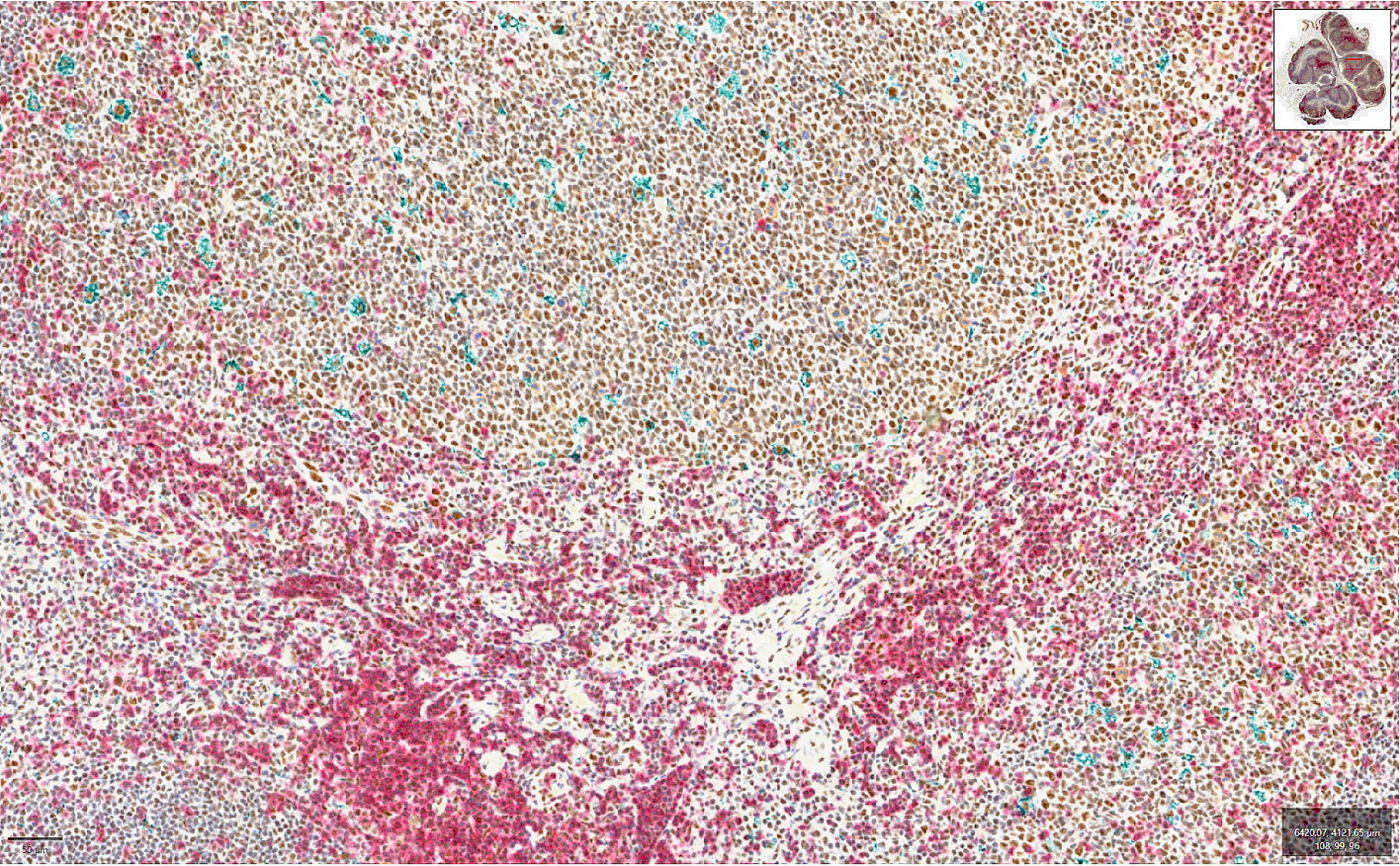 Fig 5. Human Tonsil Triplex CD3 + HAF + CD68
