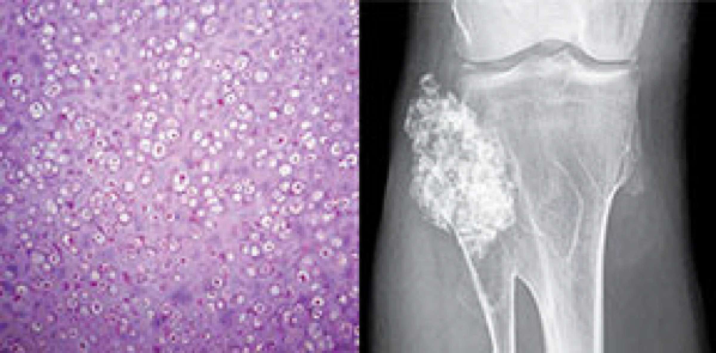 The tumor above, a peripheral chondrosarcoma just below the knee, devloped in a man who carries a mutated version of the EXT1 gene.