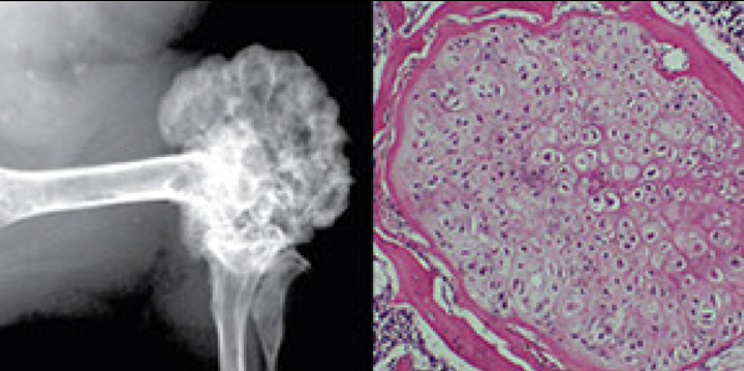The peripheral chondrosarcoma seen just above the knee to the right was genetically induced by silencing the Ext1 gene in chondrocytes in the mouse.