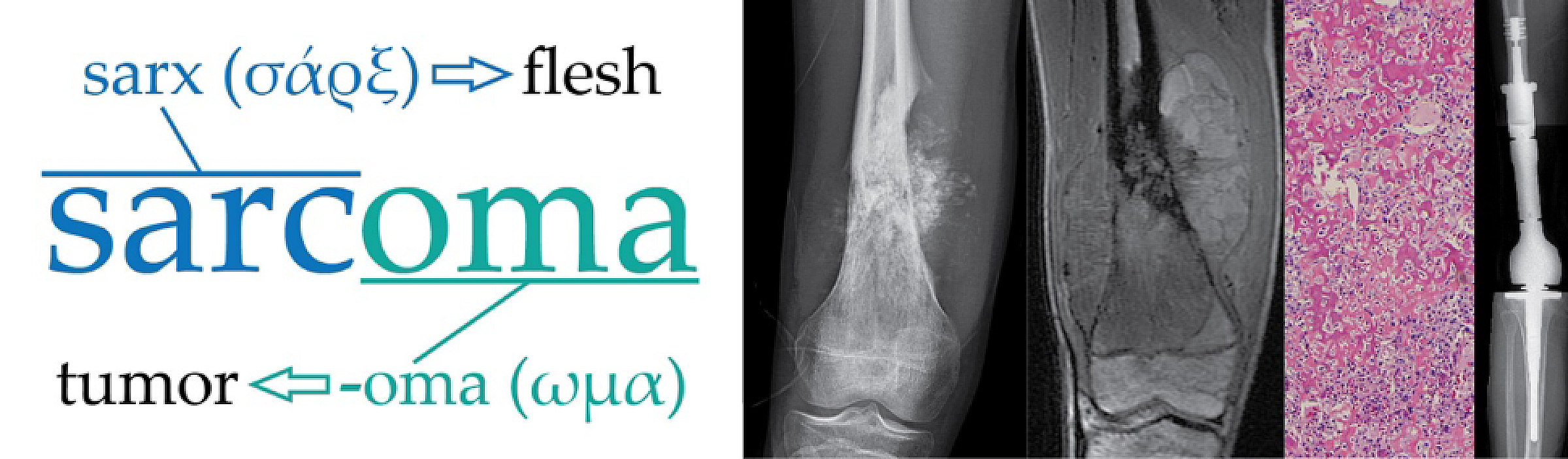 Word sarcoma spelled out; sarx means flesh and oma means tumor